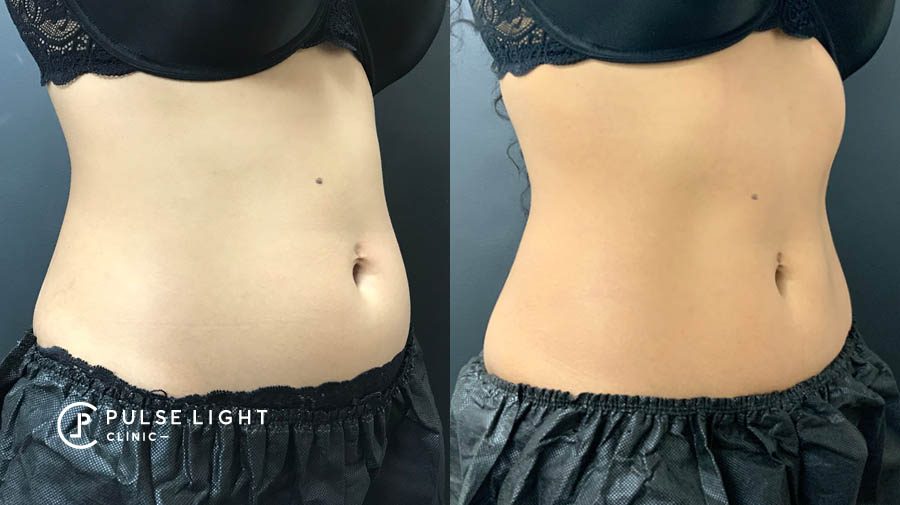 CoolSculpting Fat Freezing Abdomen