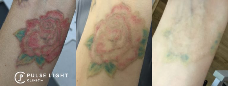 rose tattoo before and after laser tattoo removal results