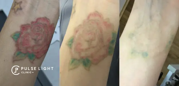 rose tattoo before and after laser tattoo removal results