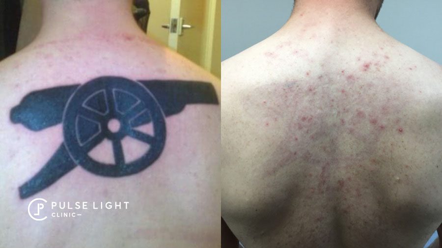 Laser Tattoo Removal London, As seen on BBC London