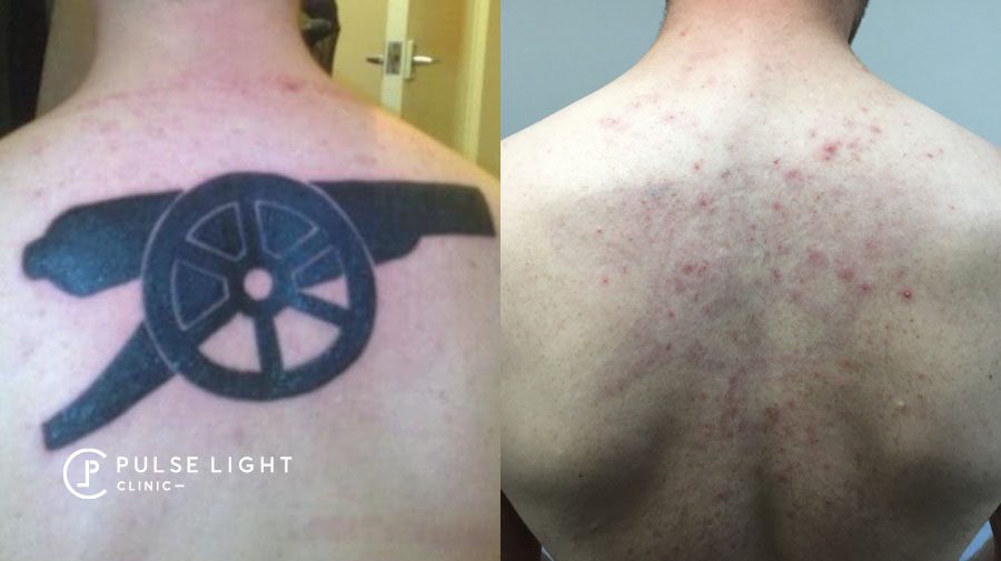 Tattoo Removal London  Stunning Results  Paul Banwell