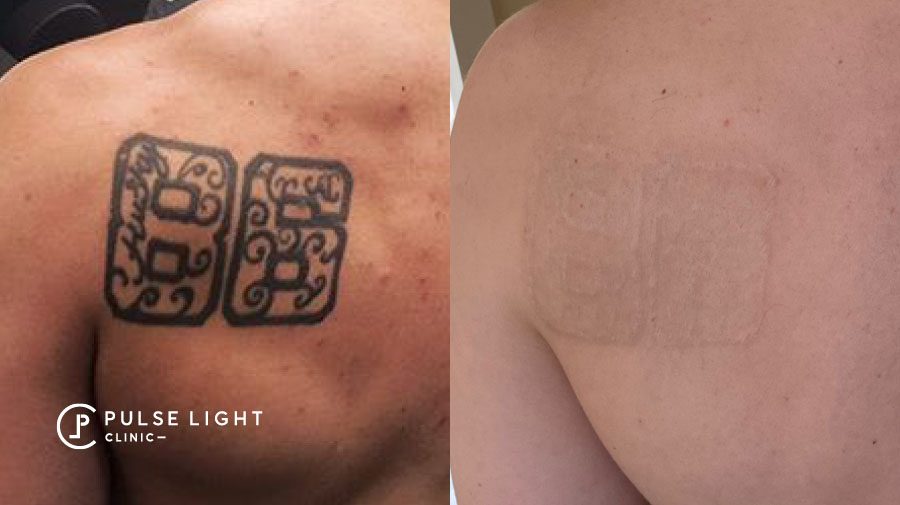 Laser Tattoo Removal Brisbane  Injex Clinics