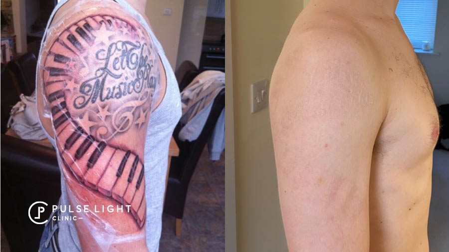 Full and Half Sleeve Tattoo Removal  Removery