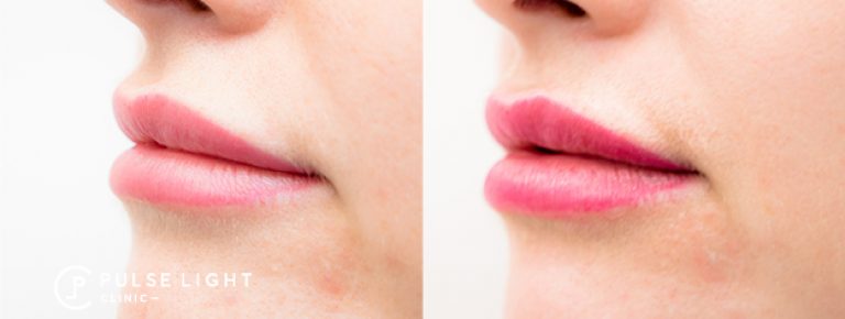 dermal filler lip before and after