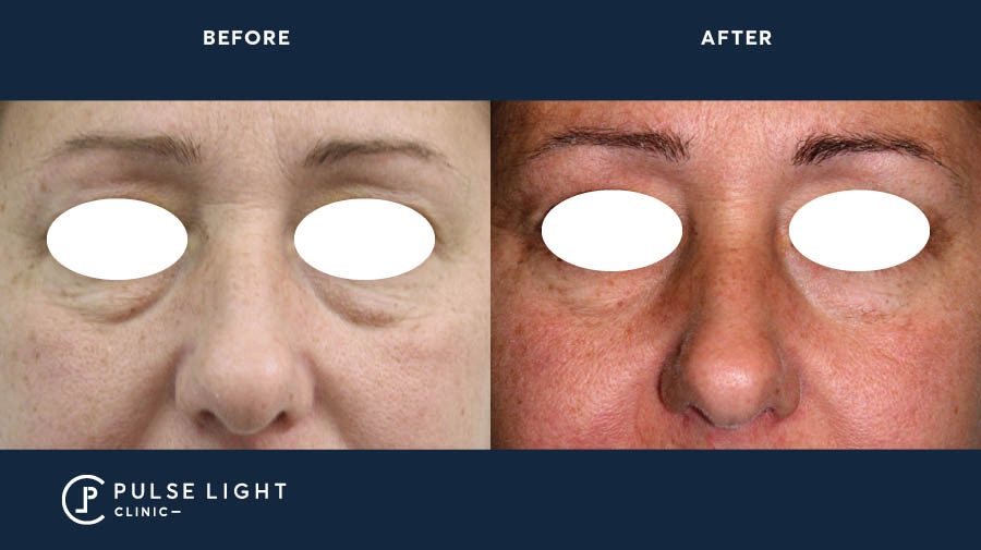 Endolift under eyes before and after