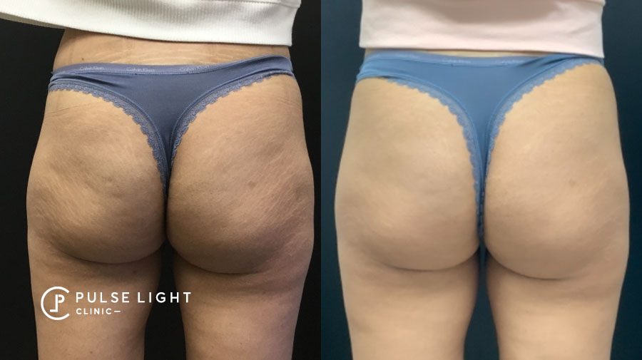 Cellulite Treatment London