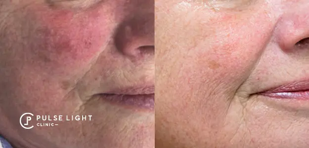 Before and after rosacea treatment results