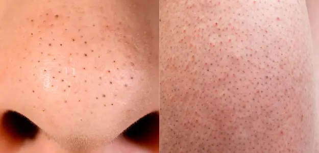 Does Laser Hair Removal Get Rid Of Blackheads? | Pulse Light Clinic London
