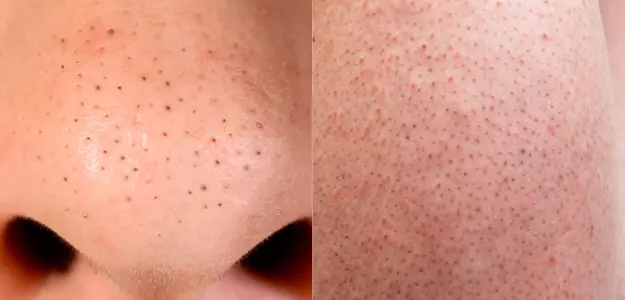 Does Laser Hair Removal Get Rid Of Blackheads? | Pulse Light Clinic London Does Laser Hair Removal Get Rid Of Blackheads? | Pulse Light Clinic London