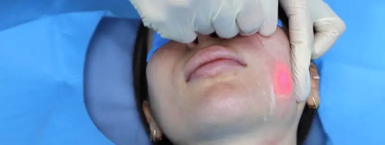 Endolift laser treatment and results.