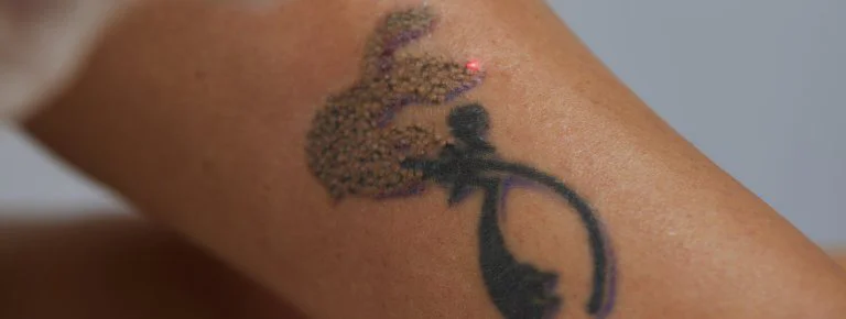 Tattoo Removal Process | Laser Tattoo Removal Houston | Clearstone Laser  Hair Removal & Medical Spa | Clearstone Laser Hair Removal & Medical Spa