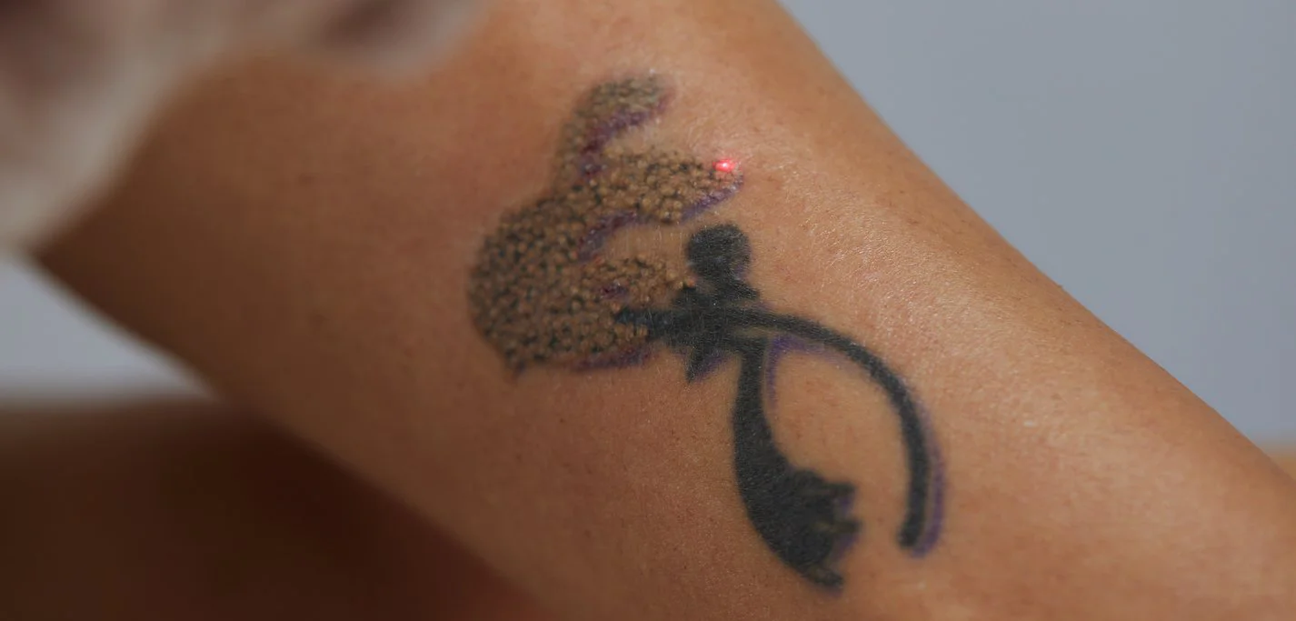A Guide to Everything You Should Know About Tattoo Removal