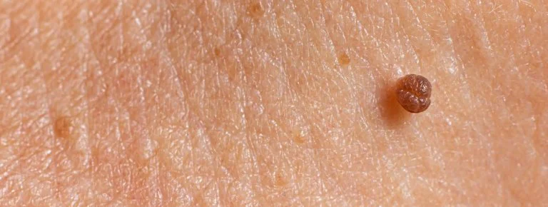 How to get rid of Skin Tag