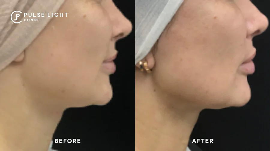 Defined Jawline before and after morpheus8
