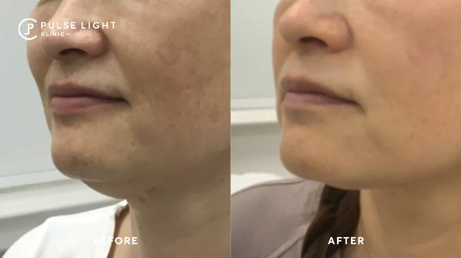 Morpheus 8 before and after double chin