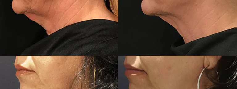 Laser Skin Tightening Before And After