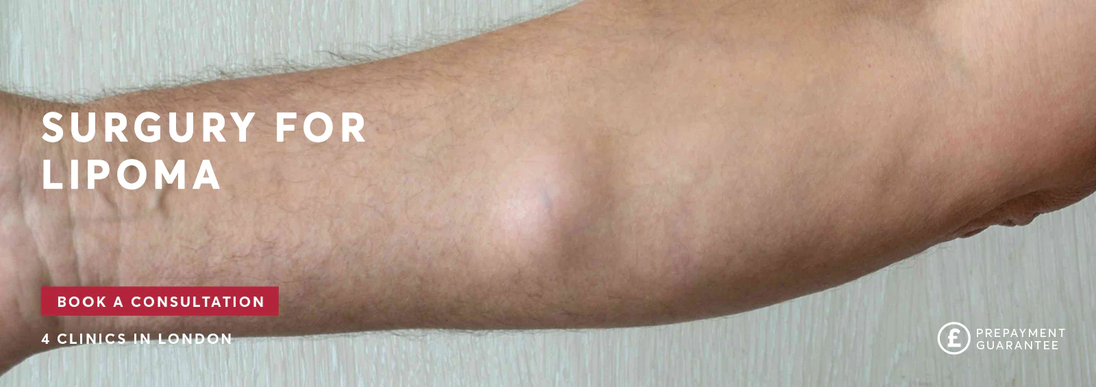 Lipoma Removal Pulse Light Clinic