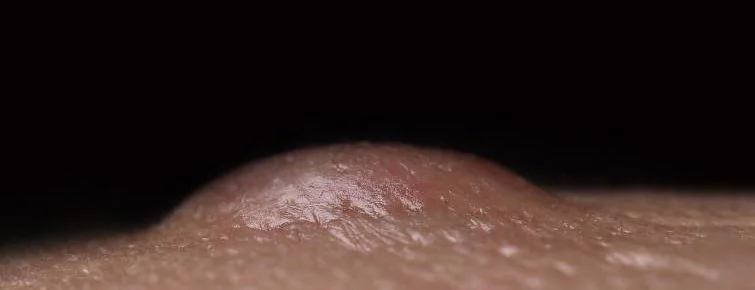 Understanding Lipomas, Cysts, and Moles: What Are They and How Do They Differ?