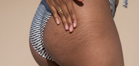 Laser Therapy for Stretch Marks