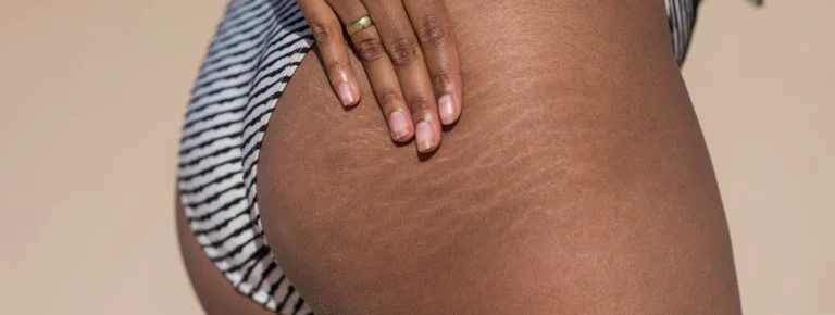 Laser Therapy for Stretch Marks