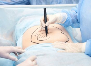 Liposuction London