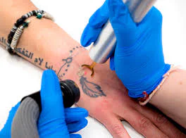 Laser Tattoo Removal London