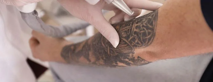 Laser Tattoo Removal: Understanding Side Effects and Aftercare
