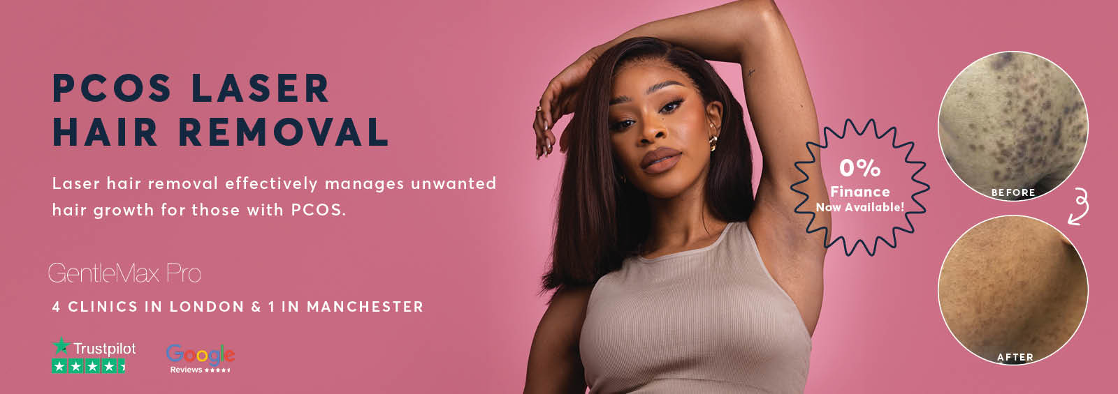 pcos laser hair removal near me