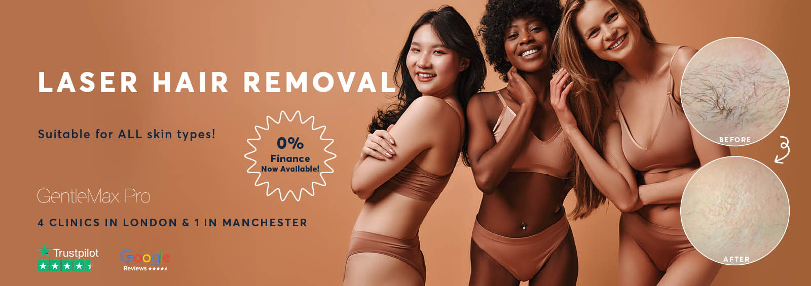 Laser Hair Removal London
