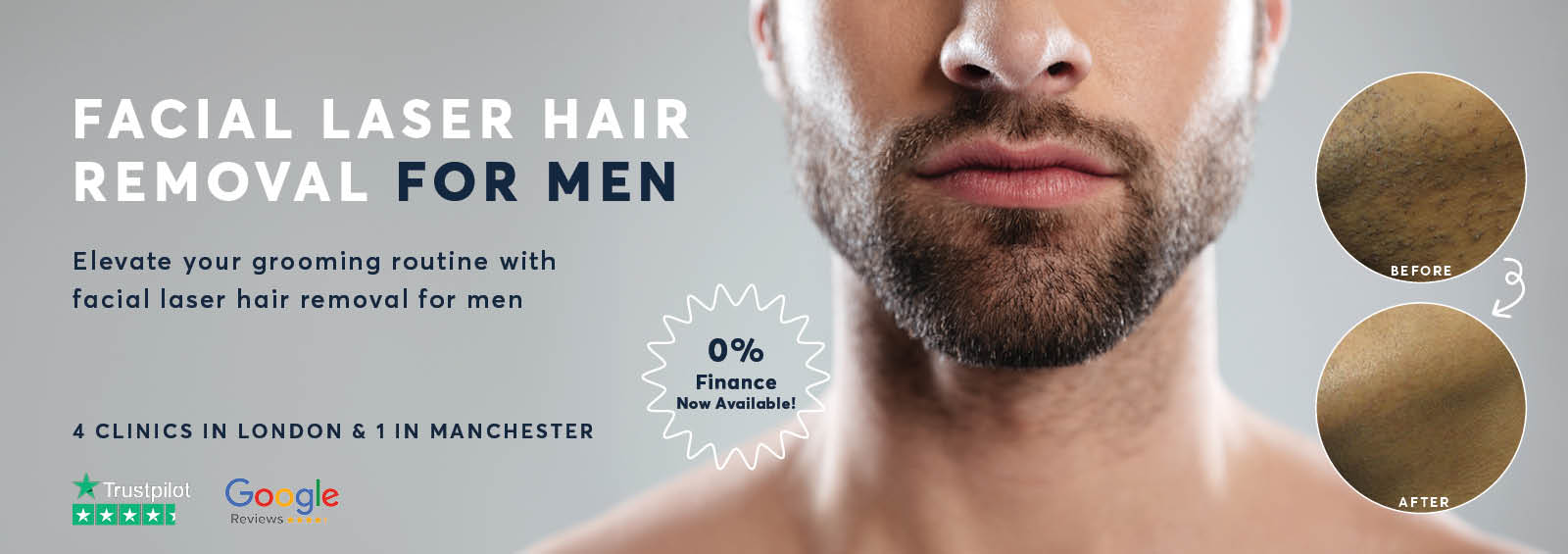 Laser Hair Removal for Men s Facial Hair Pulse Light Clinic London