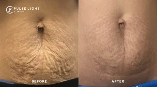 Stretch Mark Removal Pulse Light Clinic London