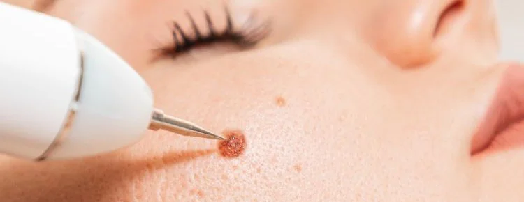 Wart Removal Near Me London