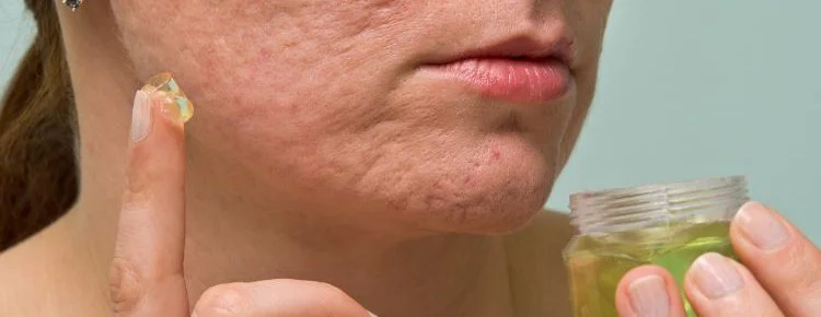 How to Treat Chickenpox Scars